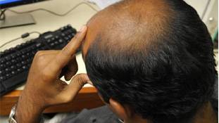 गंजेपन का रामबाण इलाज 'दुर्घटनावश' ही मिल सकता था