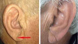 दिल की बीमारी का शक है तो पहले कान का आकार देख लें