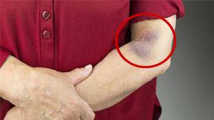 Blood platelets में कमी का मतलब सिर्फ डेंगू नहीं