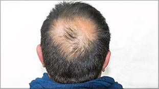 'सिर पर बाल उगाना' क्या चुनावी मुद्दा हो सकता है? साउथ कोरिया में तो है