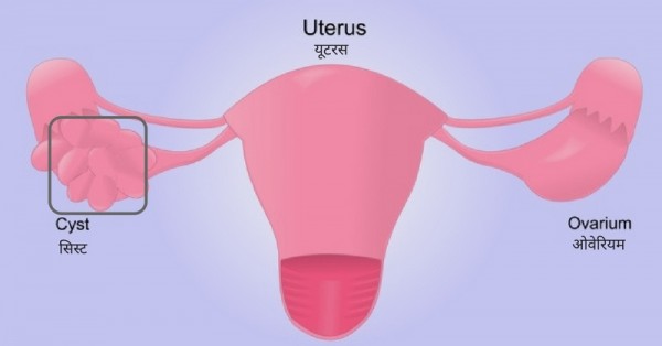 PCOS (5)