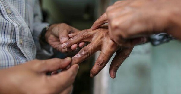 कुष्ठ रोगी की एक तस्वीर भारत में कुष्ठ रोग इलाज की पुख्ता व्यवस्था है और जल्दी बीमारी का पता चलने से मरीज विकलांगता से भी बच रहे हैं.