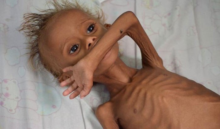 यमन के एक अस्पताल में भर्ती कुपोषित बच्चा. UNICEF के मुताबिक, यमन में 18 लाख से ज्यादा बच्चों को सबसे गंभीर किस्म का कुपोषण है. इतना गंभीर कि ये जानलेवा स्थिति है.