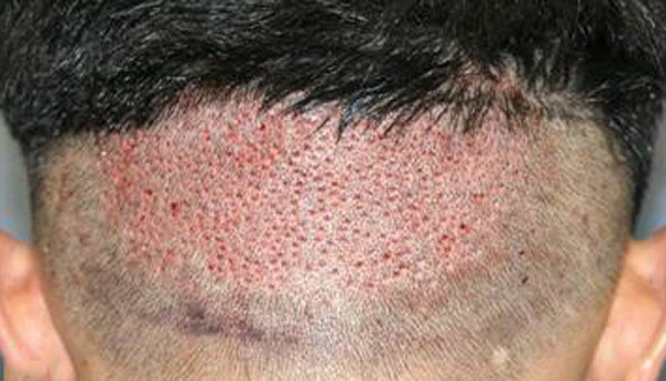 फॉलिक्यूलर एक्सट्रेक्शन का एक नमूना. (तस्वीर साभार: Bernstein medical)