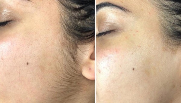डर्माप्लेनिंग को फेस शेविंग भी कहते हैं. (सांकेतिक तस्वीर: healthline) Derma Healthline