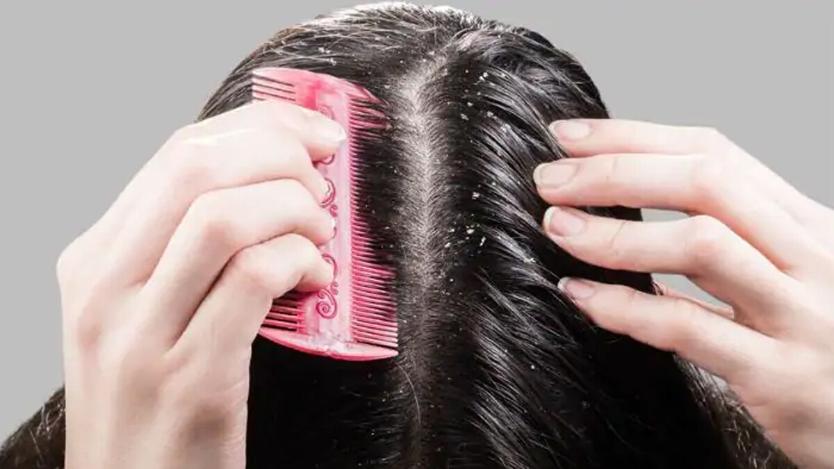 Health tips : किसी भी एंटी-डैंड्रफ शैम्पू का उपयोग करने से पहले इन 5 कारकों को जान लें, आप अभी