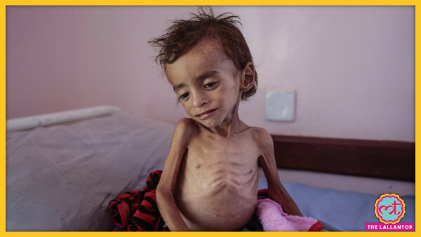 अफ्रीका की आबादी का बड़ा हिस्सा कुपोषण का शिकार है. (तस्वीर: एपी) Malnutrition Africa