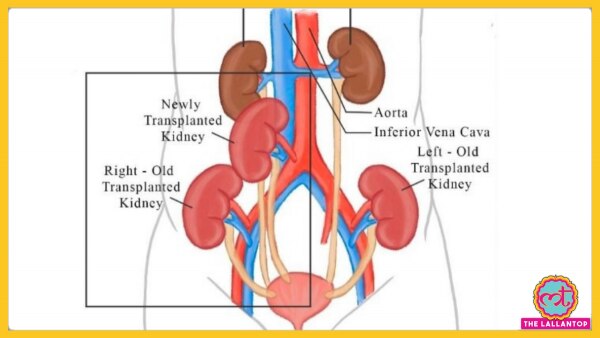 ब्लीडिंग और मरीज की जान खतरा देखते हुए डॉक्टरों ने पहले से प्रतिरोपित व स्थायी किडनियों को नहीं हटाया. (फोटो: साभार मद्रास मेडिकल मिशन हॉस्पिटल, चेन्नई) Untitled Design (46)
