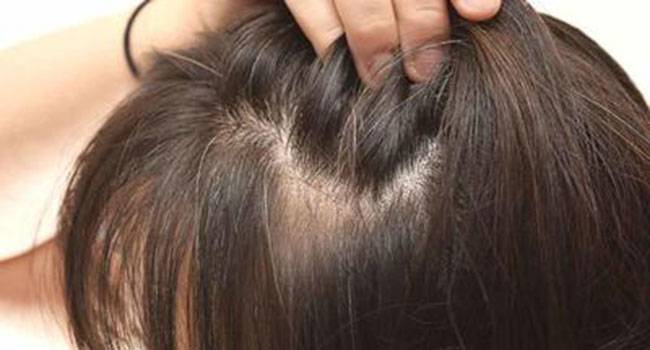 Hair loss can be a great trouble! Know about the causes and therapies Hair loss can be a great trouble! Know about the causes and therapies