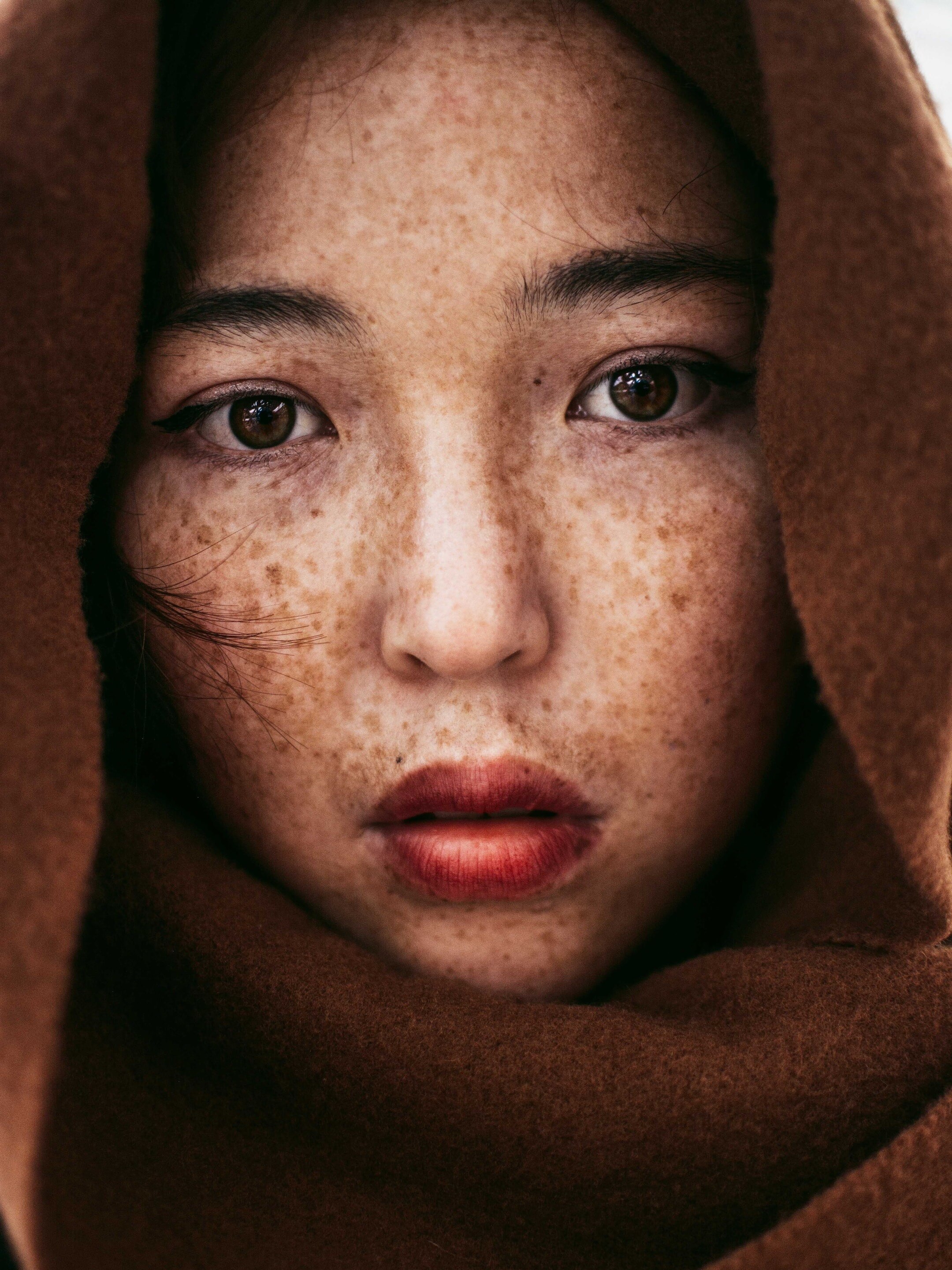 রাতারাতি ব্রণ থেকে মুক্তি পাওয়ার উপায়