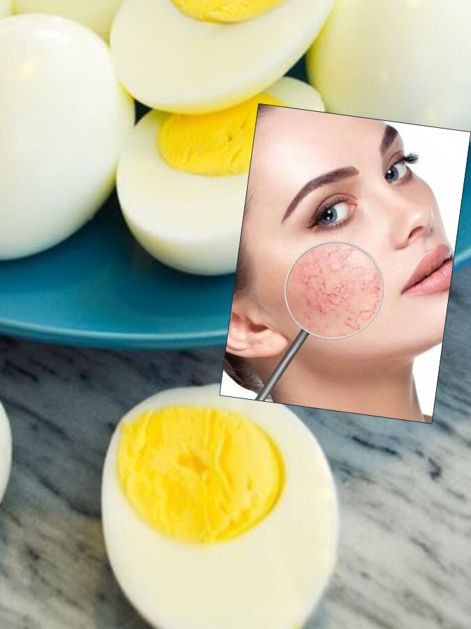 अंडा को ये लोग हमेशा कहें NO - These diseases are disadvantages of eggs