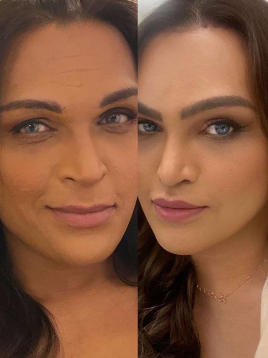 ट्रांसवुमन सायशा शिंदे ने कराई फेस सर्जरी, बयां की दर्दभरी दास्तां