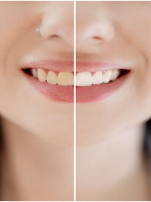 দাঁতের হলদেভাব দূর হবে কীকরে?