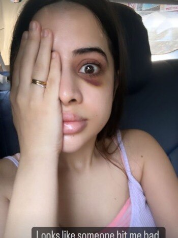 उर्फी को किसने पीटा? आंख पर चोट- सूजे होंठ, बिगड़ा हुलिया देख लोग परेशान