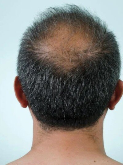 টাক পড়া এড়ানোর ঘরোয়া প্রতিকার