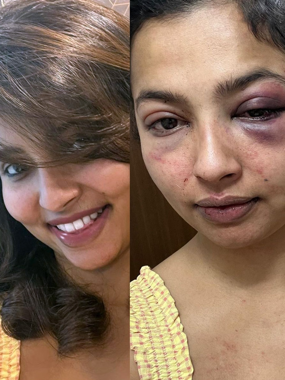 मुक्के मारे-दबाया मुंह, एक्ट्रेस के चेहरे पर चोट के निशान, Ex बॉयफ्रेंड ने पीटकर बिगाड़ा हुलिया