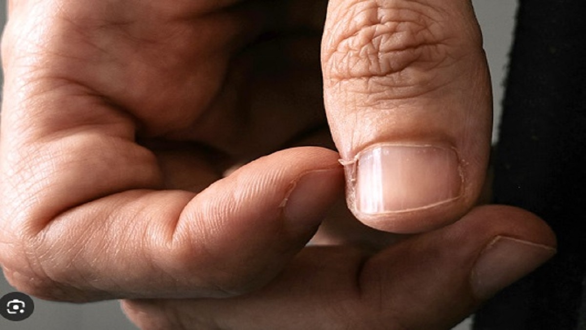 заусеницы на руках причина и лечение