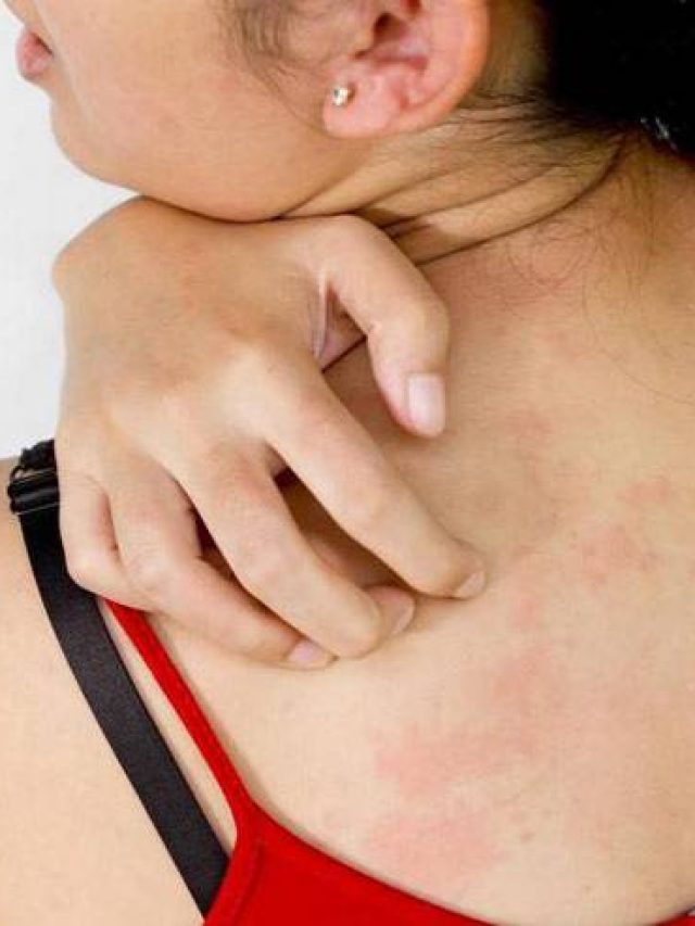 এই ৩ ঘরোয়া উপায়ে ২৪ ঘণ্টাতেই ভ্যানিশ হবে ঘামাচি!