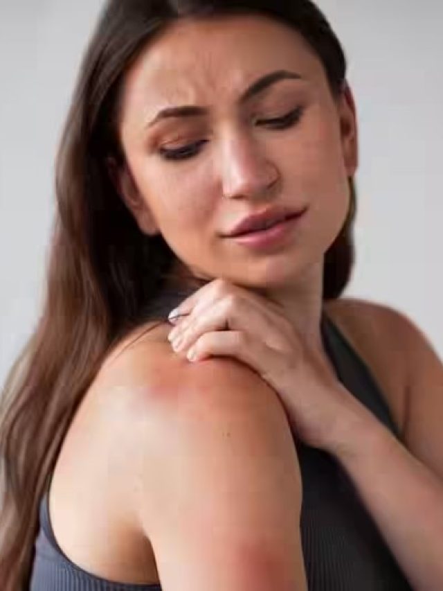 পাউডার নয়, ঘামাচি কমবে এই ৩ টোটকায়