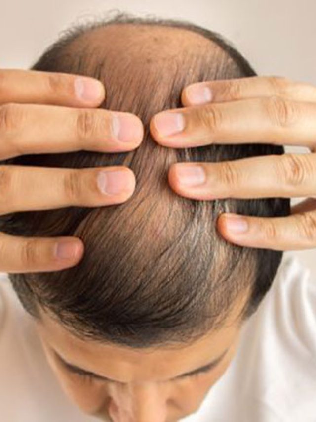 চুল নিয়ে এই ৫ ভুলই টাক পড়ার কারণ