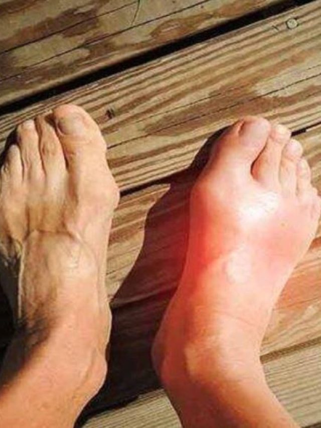 এই এক পাতাতেই কন্ট্রোলে থাকবে ইউরিক অ্যাসিড