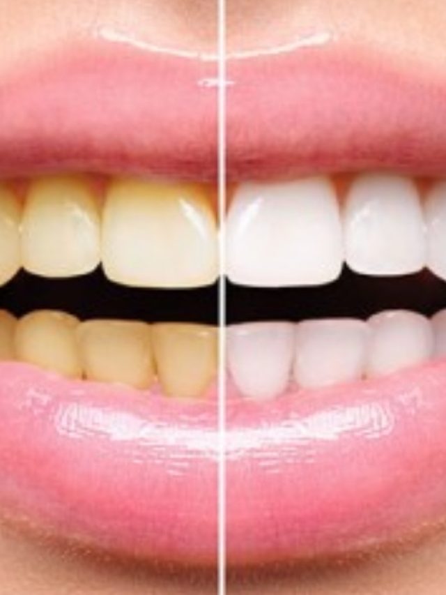 দাঁতে কালো-হলুদ ছোপ? দূর করুন এসব ঘরোয়া উপায়ে
