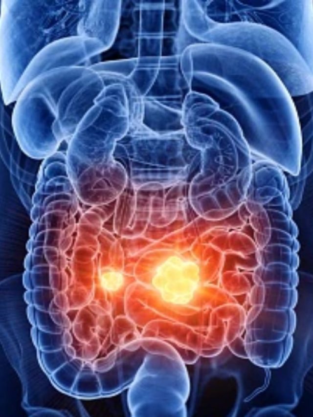 এই ৫ জিনিস বেশি খেলেই কিডনি ফেল, অনেকেই জানেন না