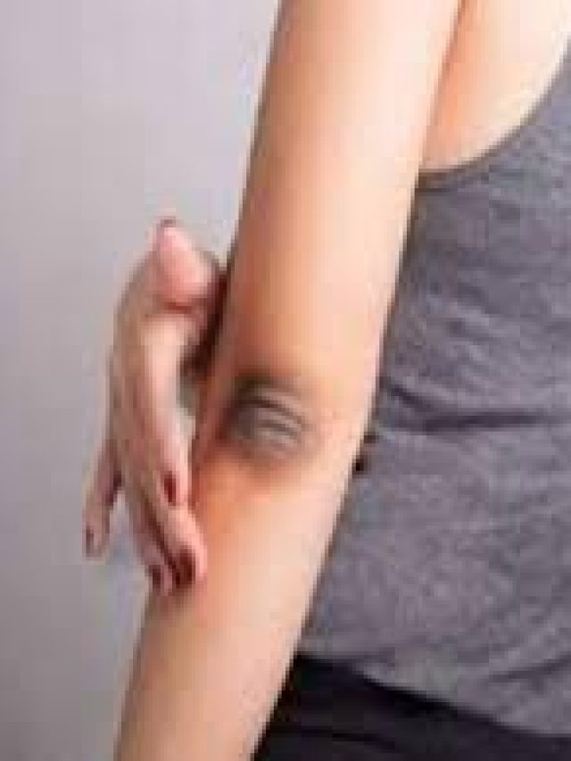 কনুইয়ে কালো দাগ? এসব ঘরোয়া উপায়ে দূর করুন