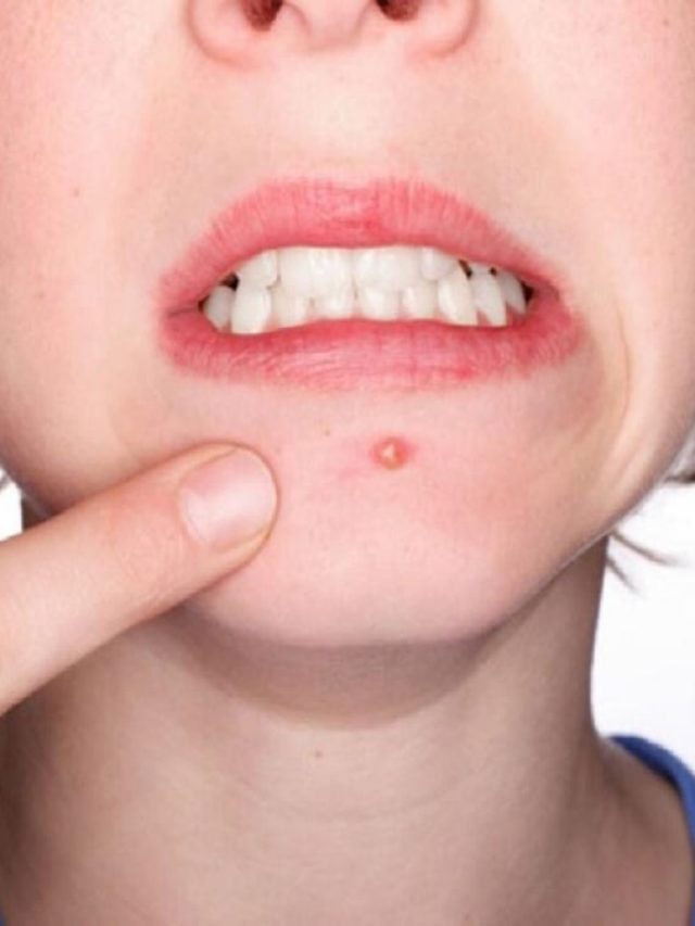 পুজোর আগে ব্রন নিয়ে চিন্তা? রইল ঘরোয়া সমাধান