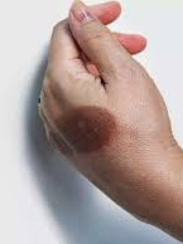 রান্না করতে গিয়ে ছ্যাঁকা লেগে পুড়ে গেছে? প্রথমেই যা করবেন