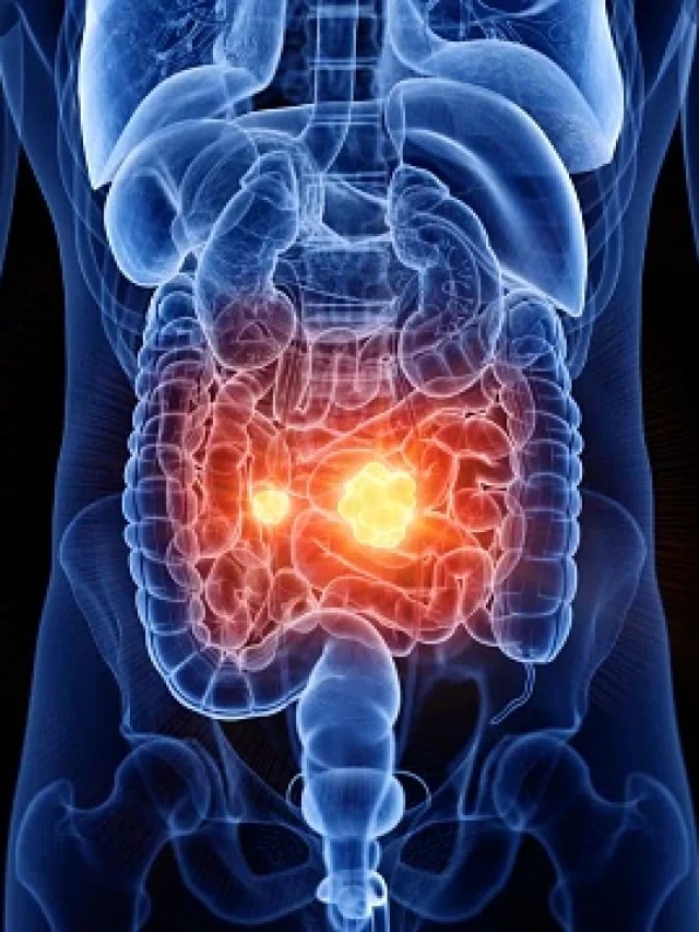 এই ৭ খাবারে পরিষ্কার হয় কিডনি, হবে না পাথর