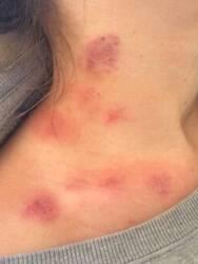 আদরের দাগ লোকাতে ব্যর্থ? রইল ঘরোয়া টোটকা