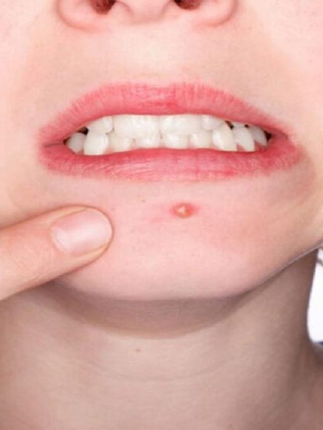 তৈলাক্ত ত্বক, ব্রণতে জেরবার? বিজ্ঞানসম্মত পন্থায় পাবেন মুক্তি