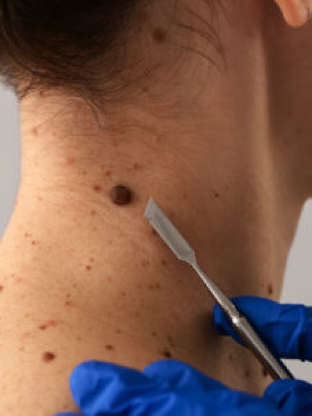 আঁচিল গায়েব হবেই, ঘরোয়া উপায় রইল