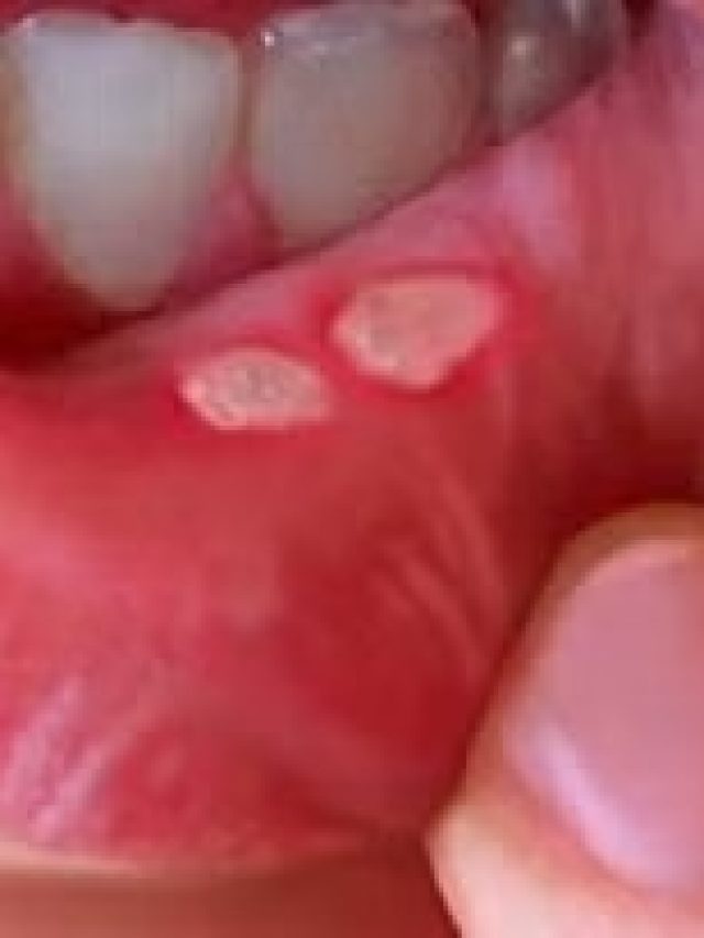 বারবার মুখে-জিভে ঘা হচ্ছে? ৫ ঘরোয়া টোটকায় সমাধান