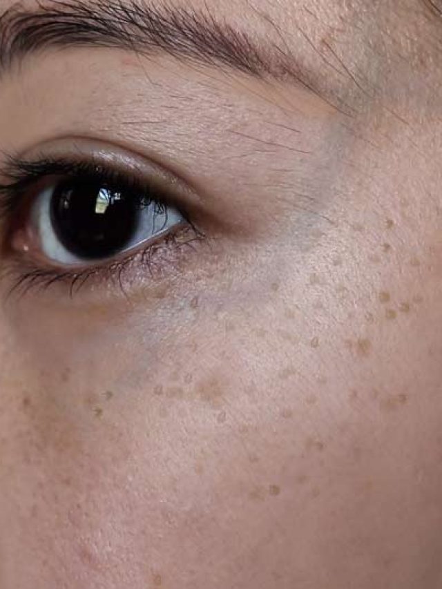 কাজের চাপে মুখে কালো ছোপ, মোক্ষম টোটকায় মুক্তি