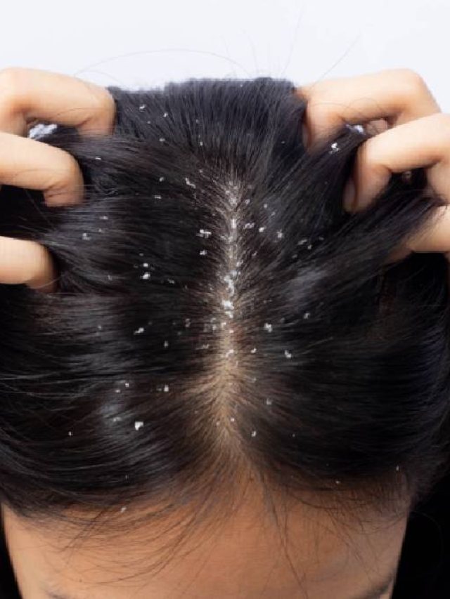 খুশকির সমস্যা বেড়েছে, ঝরছে চুলও, রয়েছে ঘরোয়া মুক্তির উপায়