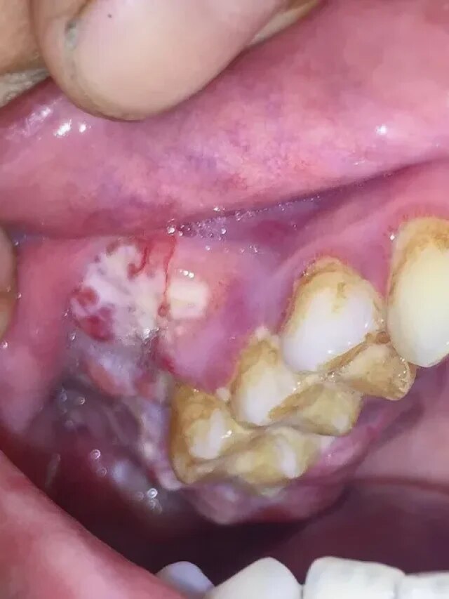 সাবধান, মুখের ক্ষত থেকে হতে পারে ক্যানসার