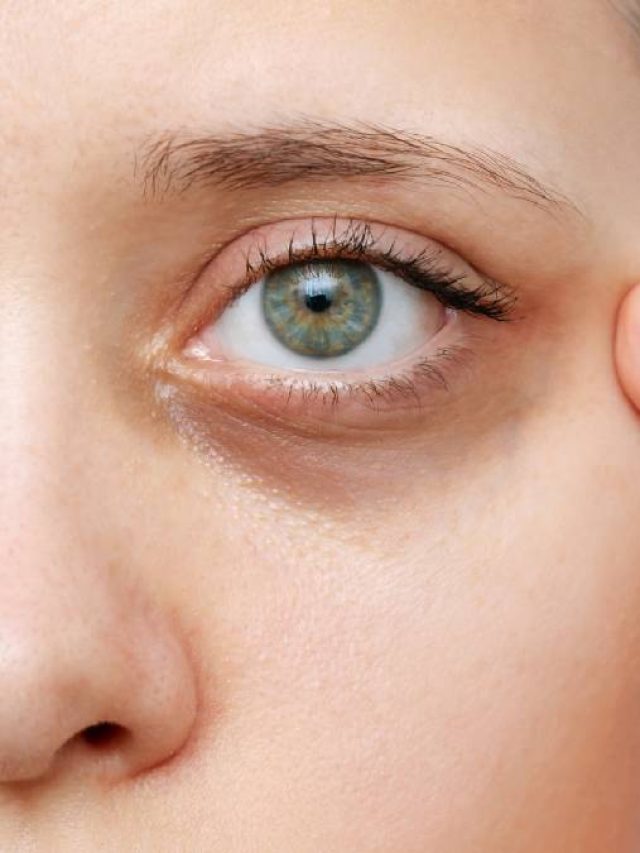 লাগবে না আইক্রিম, ঘরোয়াভাবে দূর করুন ডার্ক সার্কেল