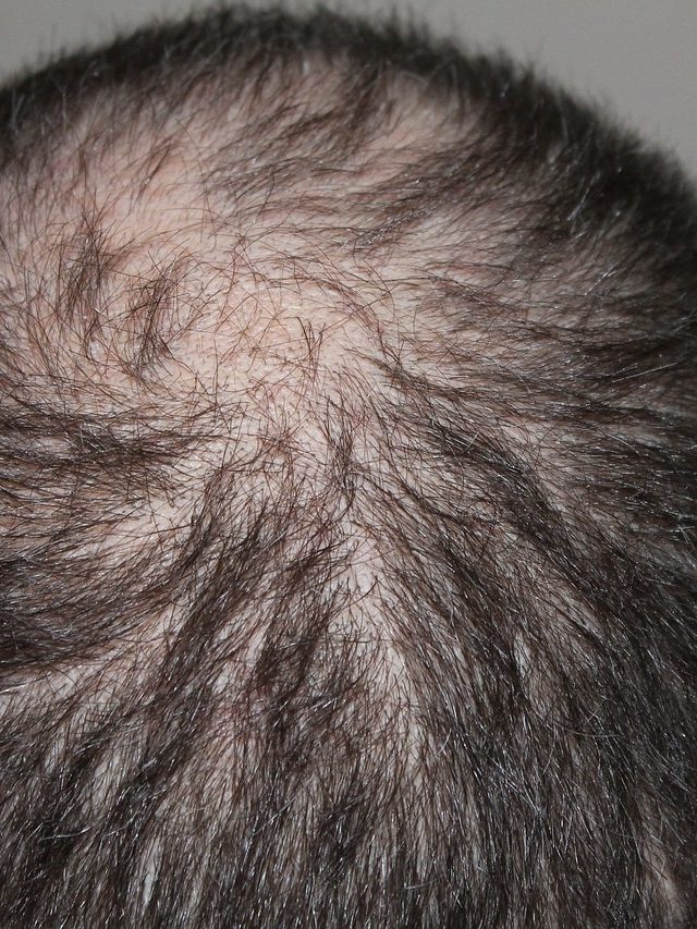 টাকে গুঁড়ি গুঁড়ি চুল গজাবে, এই ৭ নিয়ম মুখস্থ করে নিন