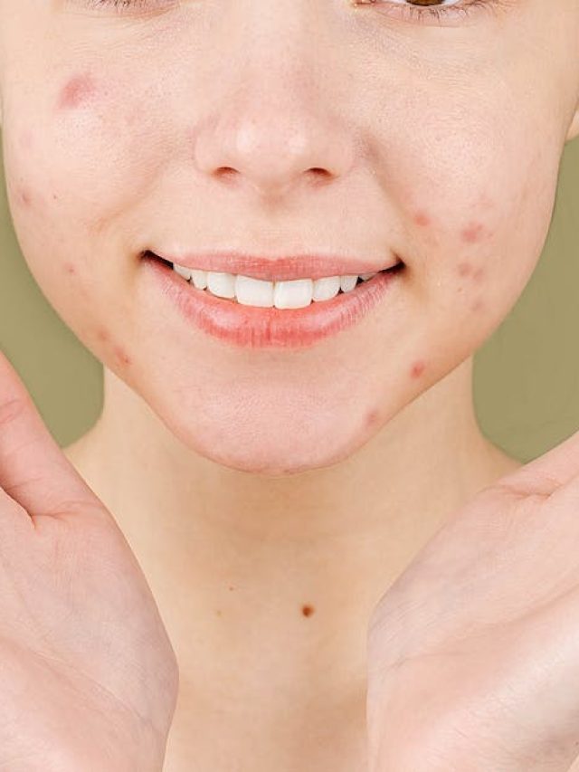 ব্রণ থেকে মুক্তি পেতে জাদুকরী গোলাপ জল