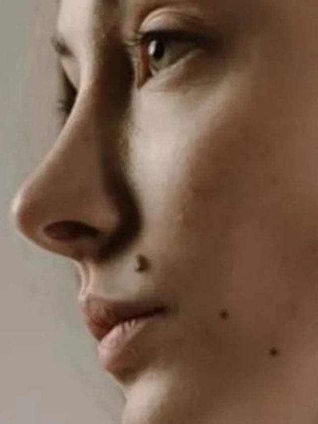 আঁচিলে লোম ওঠা কি বিপজ্জনক?