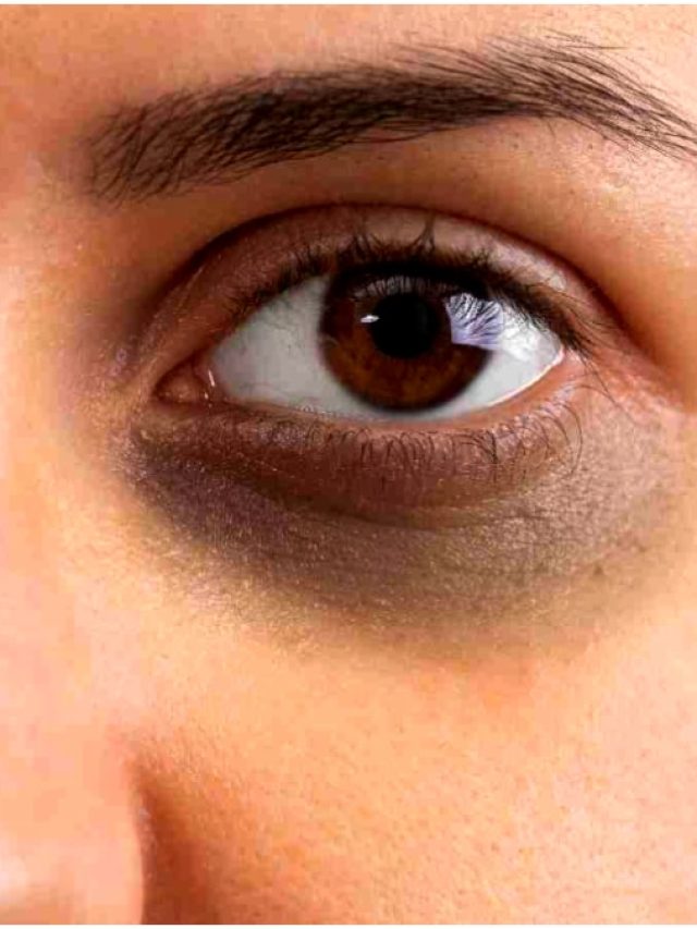 সৌন্দর্যে বাধা ডার্ক সার্কেল? রইল সহজ ঘরোয়া সমাধান