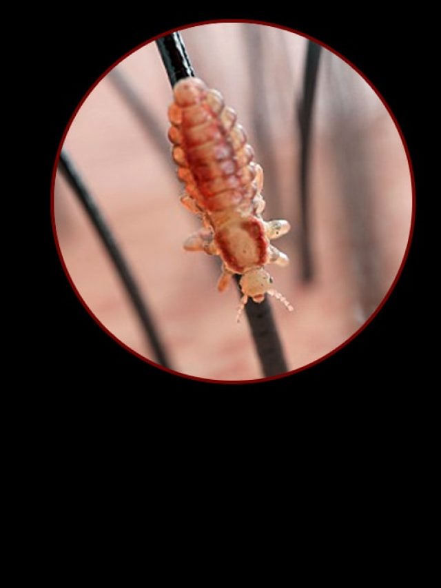 ইস! মাথা ভর্তি উকুন? তাড়ানোর সহজ টোটকা জেনে নিন