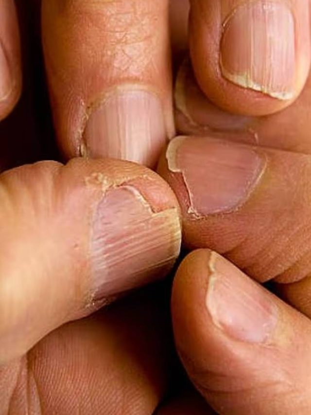 বারবার ভেঙে যাচ্ছে নখ? এই সব ভিটামিনের অভাব