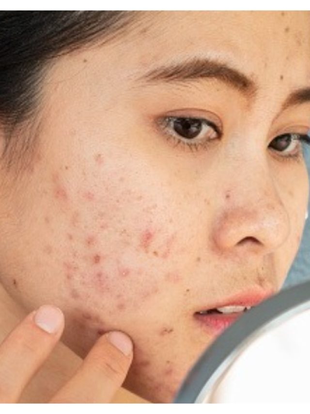 রাতারাতি  ব্রণ কমবে ঘরোয়া টোটকায়, পুজোর আগে টিপস