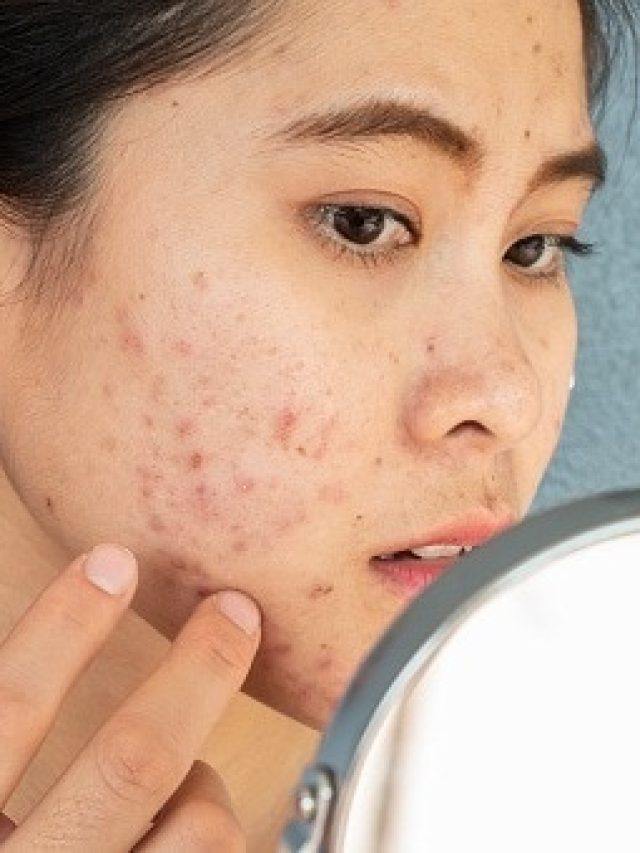 গ্যারান্টি দিচ্ছি, এসব উপায়ে দূর হবে ব্রণ ও ব্রণর দাগ