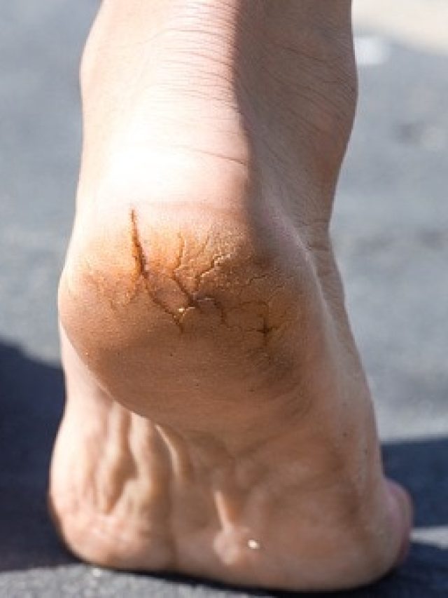 ফাটা গোড়ালি নিয়ে আর চিন্তা নয়, রইল ঘরোয়া সমাধান