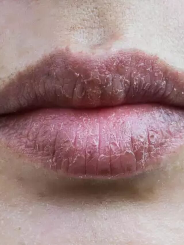 জল খেয়েও শুকোচ্ছে ঠোঁট? দায়ী এই ৪ ভিটামিনের অভাব
