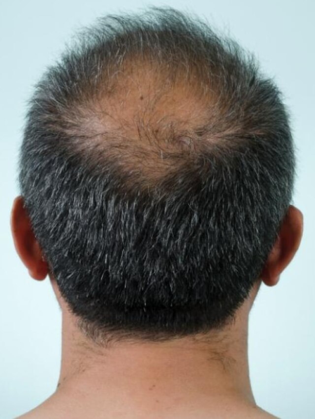 এই ফলের ৪ ফোঁটা রসে টাক ঢাকবে চুলে, শুধু লাগান এভাবে